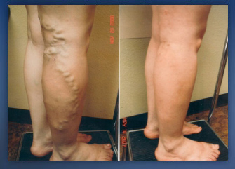 Overcome Chronic Pain from the Varicose Veins in Your Legs