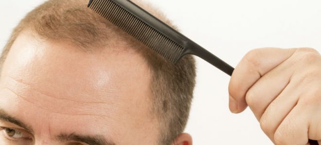 Post-Operative Recovery Care Following a Hair Transplant in CT