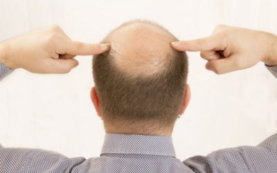 Personalized hair loss therapy in Pine Bluff, AR, for lasting results